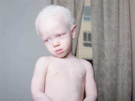 Albino Boy We Are The World People Of The World Beautiful People