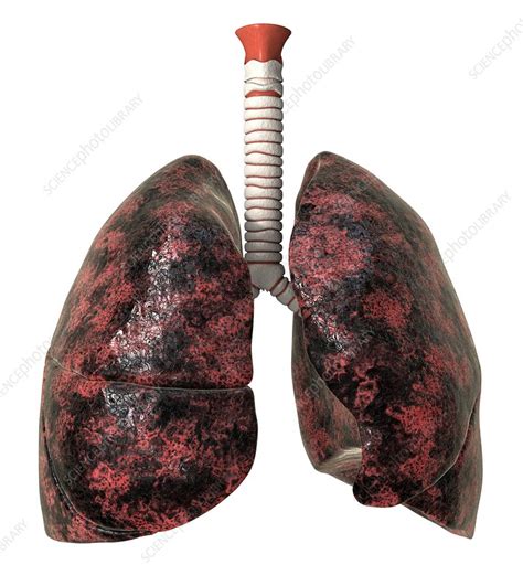 smoker s lungs artwork stock image c011 6182 science photo library