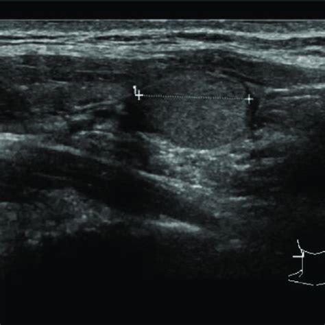 Thyroid Ultrasound Showing The Solitary Right Lower Lobe Thyroid Nodule