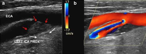 Vascular Ultrasound Of The Carotid Arteries Was Performed In A Patient