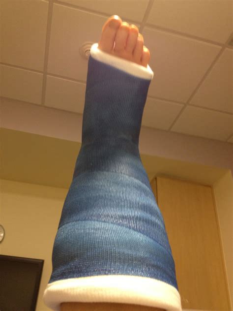 fiberglass cast 6 weeks (With images) | Ankle cast, Leg cast, It cast