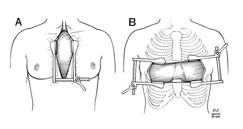 Sternal Splitting Approaches To Thymectomy For Myasthenia Gravis And