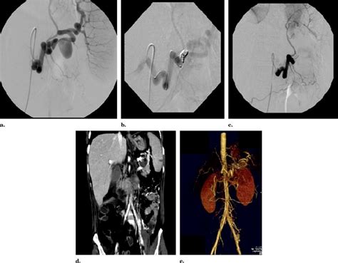Successful Endovascular Treatment Of A Splenic Artery Aneurysm In A