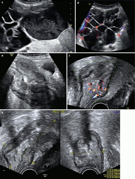 Ultrasound Evaluation Of Ovaries Obgyn Key
