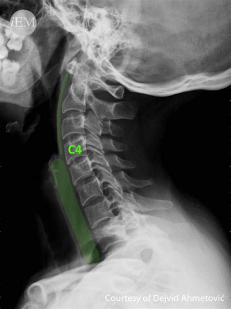How To Read C Spine X Ray International Emergency Medicine Education