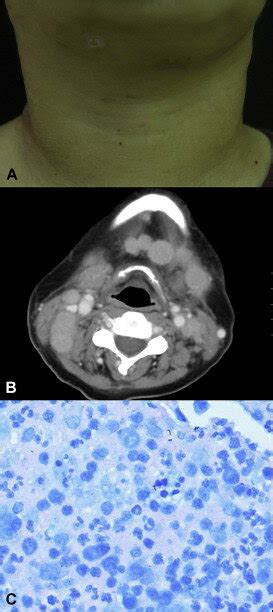 Disseminated Nontuberculous Mycobacterial Infection A Bilateral Neck