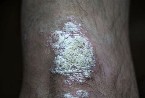 Psoriasis On Knee Of Caucasian Man Dermatological Disease Stock Photo