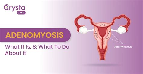 Adenomyosis Disease Symptoms Causes And Treatment