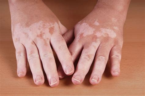 Vitiligo Causes And Treatment Of Skin Pigment Loss