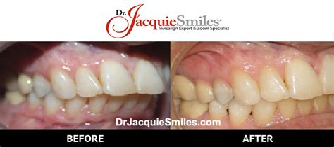 Beforeafterdr Jacquie Monroe Ortho