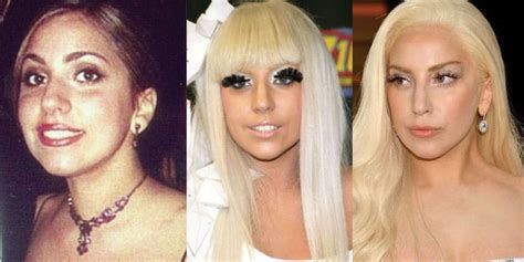 Lady Gaga Plastic Surgery Before And After Pictures