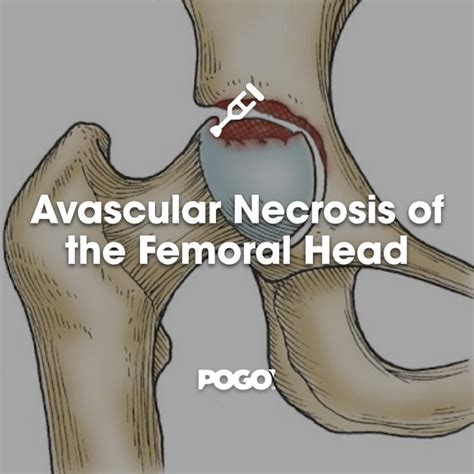 Diagnosis Avascular Necrosis Of The Femoral Head Pogo Physio Gold Coast