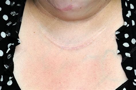Thyroidectomy Scar With Keloid Stock Image C Science