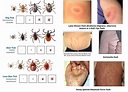 Lyme disease, Tick rash, Ticks