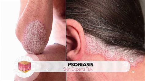 Psoriasis Treatment Options Youtube