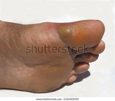 Abscess Mans Left Toe Swollen Left Foto Stock 1526302439 Shutterstock