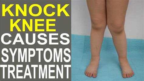 Knock Knee Causes Symptoms Treatment Genu Valgum Health Made Easy