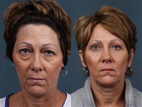 Eyelid Surgery Before After Photos Annapolis Md
