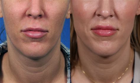 amazing upper lip cosmetic improvement from lip lifting