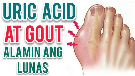 Gamot Sa Pamamaga Sanhi Ng Gout Sa Paa Pamagamo