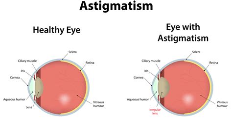 Meaning of shaped in english. Astigmatism