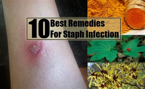 10 Best Home Remedies For Staph Infection
