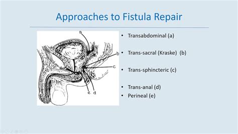 Urinary Rectal Fistulas Empire Urology Lecture Series Youtube