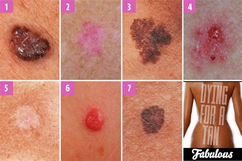 Can You Spot Which Moles Are Deadly The Skin Cancer Signs You Need To Know The Irish Sun
