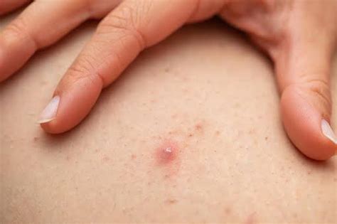 Causes Of Pimples On Legs Treatment And Outlook