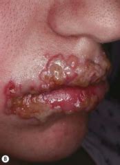 It affects the cornea, which is the clear front portion of your eye. Viral infections Flashcards - Cram.com