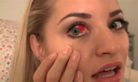 Burst Blood Vessel In Eye Symptoms Causes Treatment Hubpages