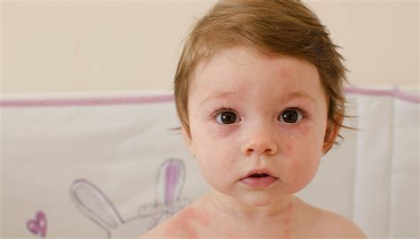 Heat Rash In Babies