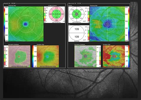 Optical Coherence Tomography Luna