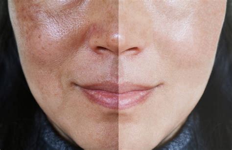 What Is The Best Melasma Treatment A Skin Clinic Solution