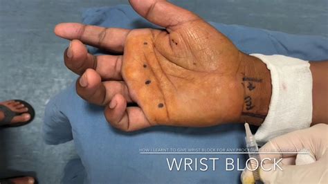 Wrist Block How To Block Ulnar Median And Radial Nerve For Hand