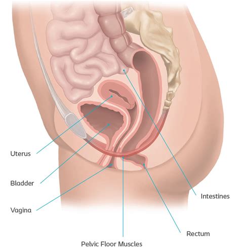 Vector illustration on isolated background. Learn More About Pelvic Organ Prolapse Symptoms & Treatments