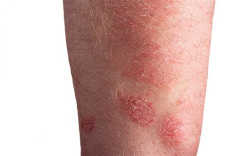 Xerotic Eczema What Is It The Seasonal Dry Eczema Stopitchy