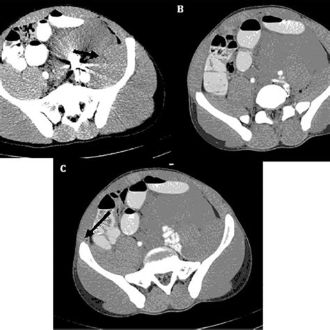Axial Abdominopelvic Ct Scan Of The Patient Demonstrating The Bullet