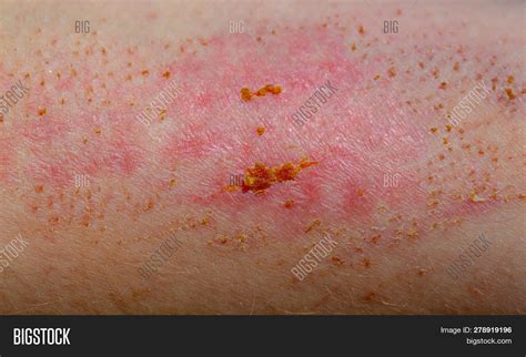 Wound On Skin Scab Image And Photo Free Trial Bigstock