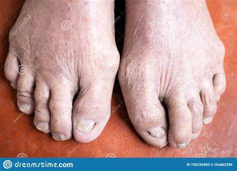 Psoriasis On The Mens Feet Treatment With Mud Stock Photo