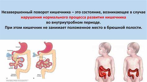 Незавершенный поворот кишечника - online presentation Картинка - Незавершенный поворот кишечника - online presentation