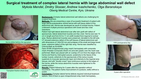 Surgical Treatment Of Complex Lateral Hernia With Large Abdominal Wall
