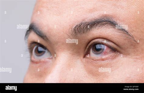 Eye Irritation Concept Macro Red Eye Of Man Conjunctivitis Eye Or
