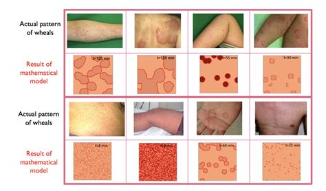 Studying The Geometry Of A Common Skin Disease Asia Research News