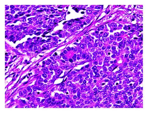 Histological Findings Of The Tumor X 400 The Tumor Was Uniform In