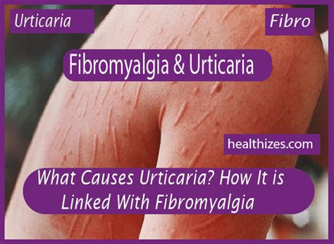 What Causes Urticaria How It Is Linked With Fibromyalgia Healthizes