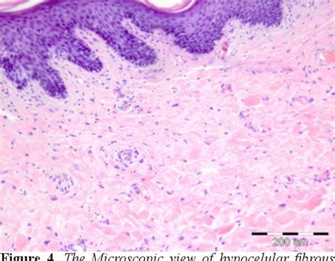Figure From Giant Fibroepithelial Polyp Of Vulva A Case Report And