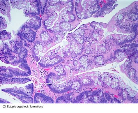 Pathology Outlines Traditional Serrated Adenoma