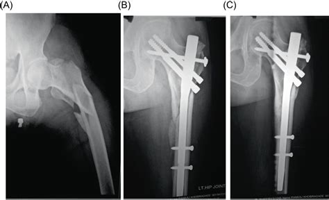 Augmentation Of Proximal Femoral Nail In Unstable Trochanteric