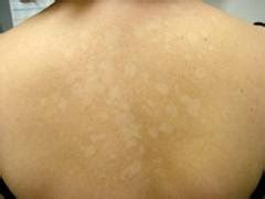 Masalah fungus atau kulat dan jangkitan fungus pada kulit boleh mendatangkan rimas dan mengganggu urusan seharian. Blog Cerita Kesihatan: PENYAKIT PANAU ADAKAH BERJANGKIT ...